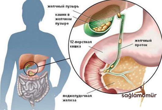 Öd kisəsində daşlar BU SƏBƏBLƏRƏ GÖRƏ əmələ gəlir